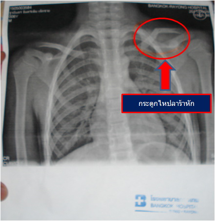 ชื่อ:  กระดูกหัก.jpg
ครั้ง: 273
ขนาด:  48.3 กิโลไบต์